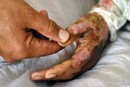 Self-immolation Survivor