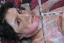 Self-immolation Survivor
