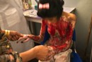 Self-immolation Survivor