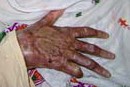 Self-immolation Survivor