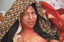 Self-immolation Survivor