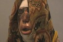 Self-immolation Survivor