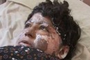 Self-immolation Survivor
