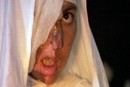 Self-immolation Survivor