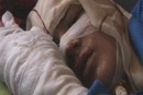 Self-immolation Survivor
