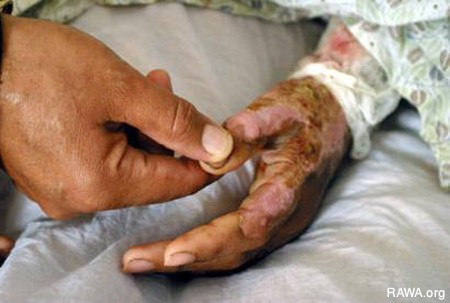 Self-Burning Among Afghan Women