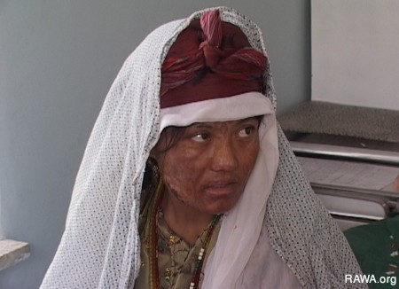 Self-Burning Among Afghan Women