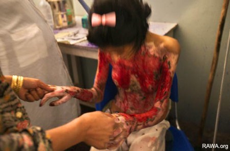 Self-Burning Among Afghan Women