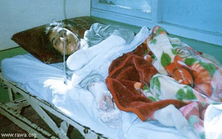 Self-Burning Among Afghan Women