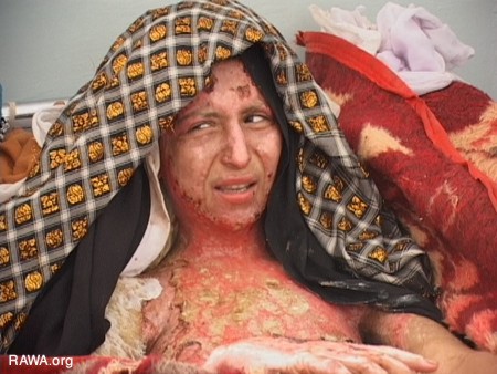 Self-Burning Among Afghan Women