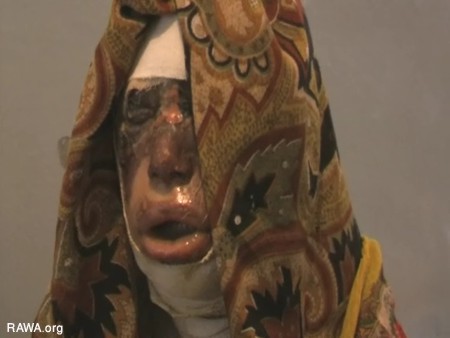 Self-Burning Among Afghan Women