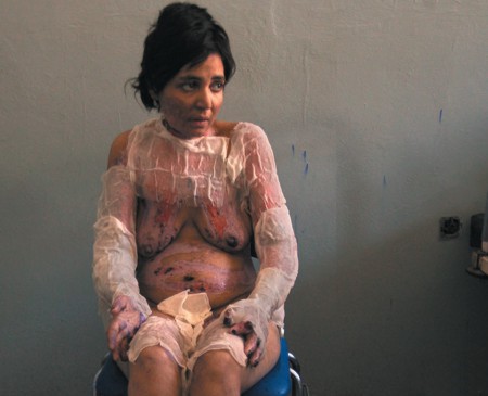Self-Burning Among Afghan Women