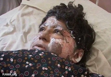 Self-Burning Among Afghan Women