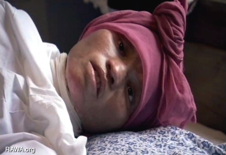 Self-Burning Among Afghan Women