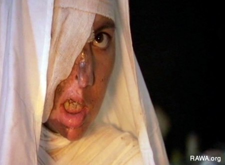 Self-Burning Among Afghan Women